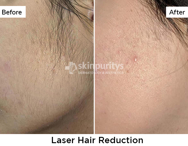 Laser Hair Reduction results